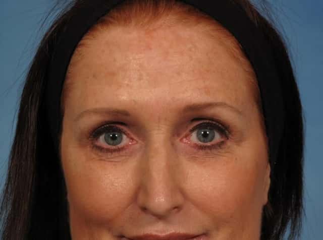 Madonna Lift Before & After Case 283 before