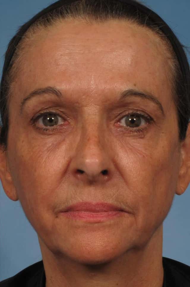 Madonna Lift Before & After Case 284 after