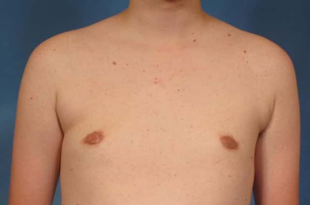 Male Breast Reduction Before & After Case 147 after