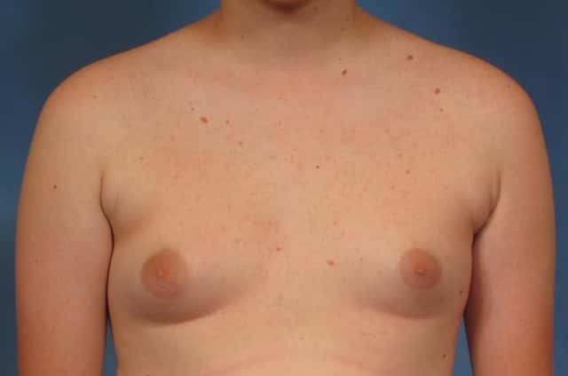 Male Breast Reduction Before & After Case 147 before