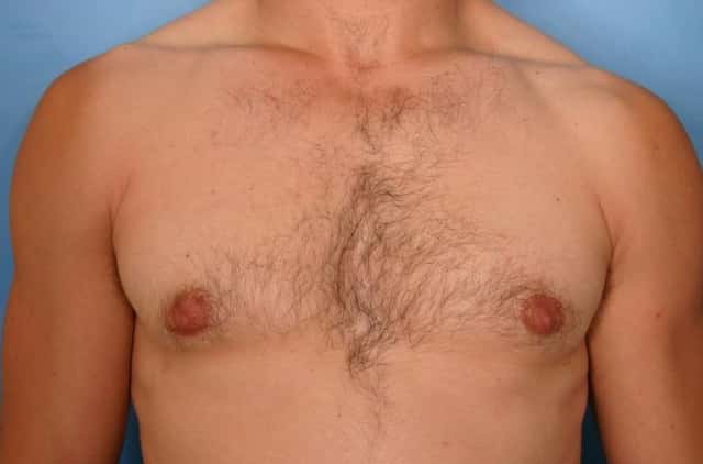 Male Breast Reduction Before & After Case 44 after