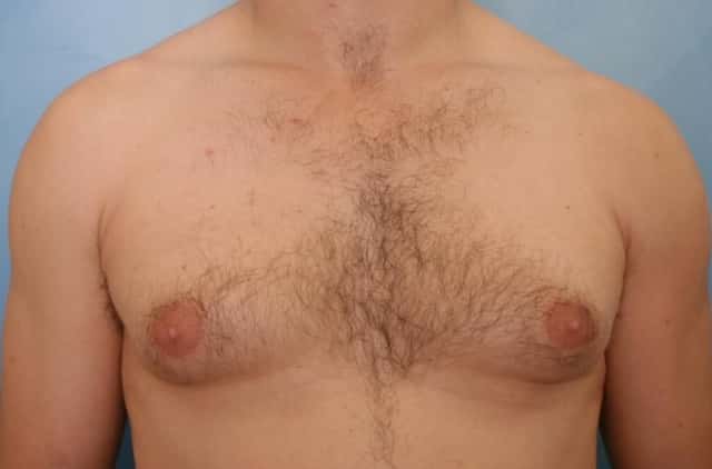 Male Breast Reduction Before & After Case 44 before