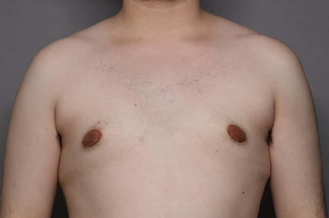 Male Breast Reduction (Gynecomastia) Frontal View 3 Months Post Op