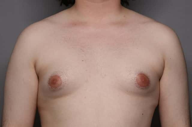 Male Breast Reduction (Gynecomastia) Frontal View Before