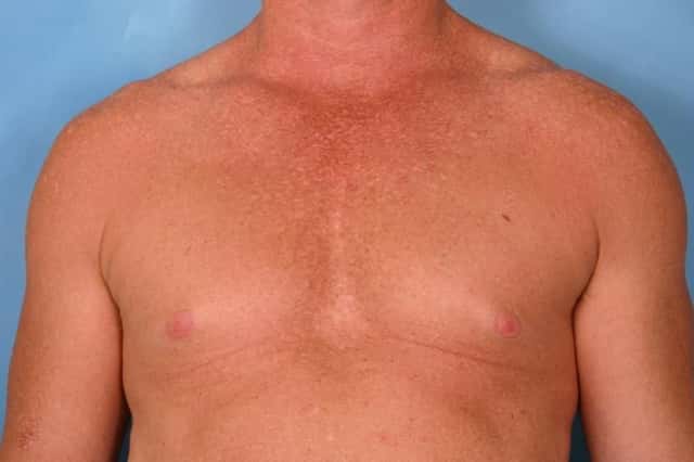 Male Breast Reduction Before & After Case 77 before