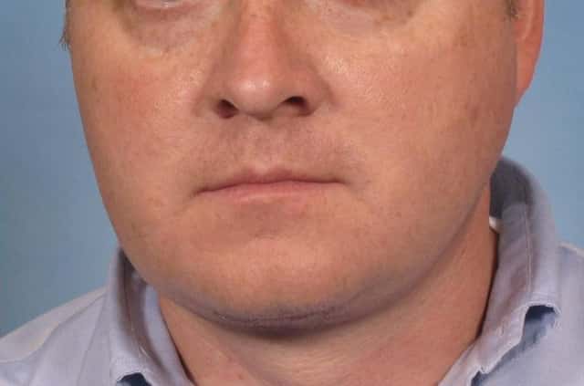 Male Face/Neck Lift Before & After Case 108 after
