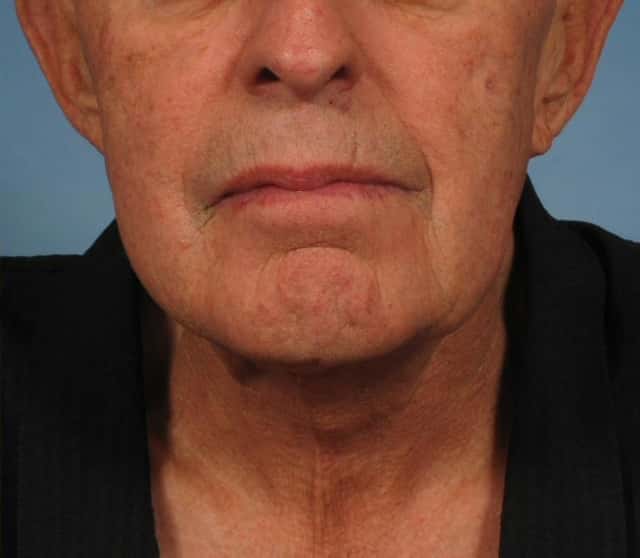Male Face/Neck Lift Before & After Case 186 after