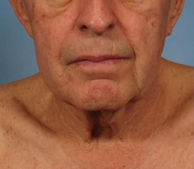 Male Face/Neck Lift Before & After Case 186 before