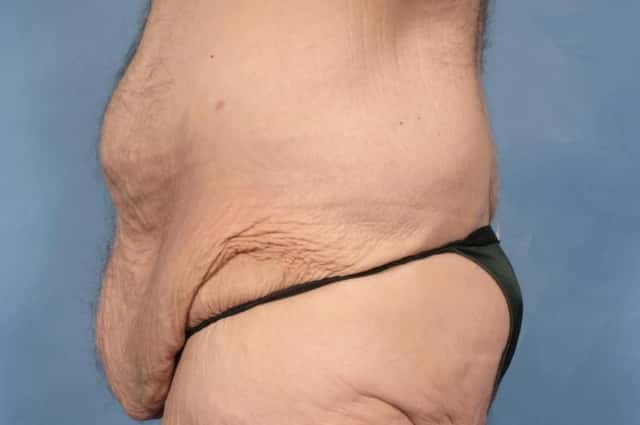 Massive Weight Loss Before & After Case 104 before