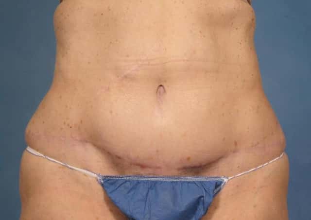 Massive Weight Loss Before & After Case 173 after