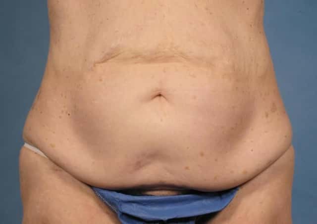 Massive Weight Loss Before & After Case 173 before