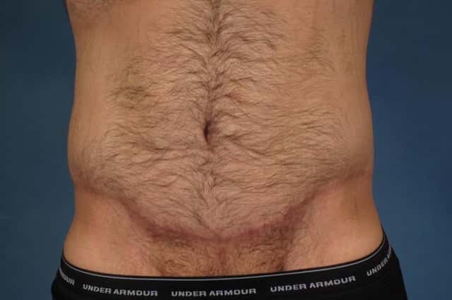 Massive Weight Loss Before & After Case 244 after