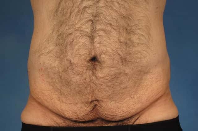 Massive Weight Loss Before & After Case 244 before