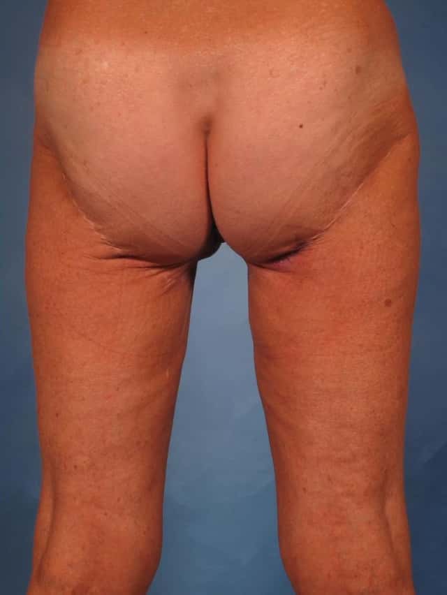 Massive Weight Loss Before & After Case 247 after