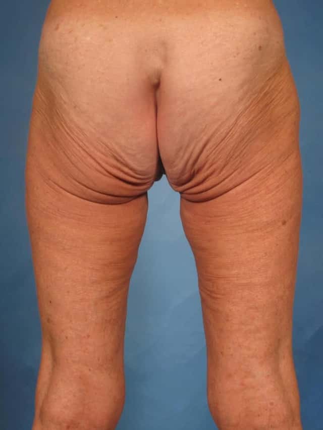 Massive Weight Loss Before & After Case 247 before
