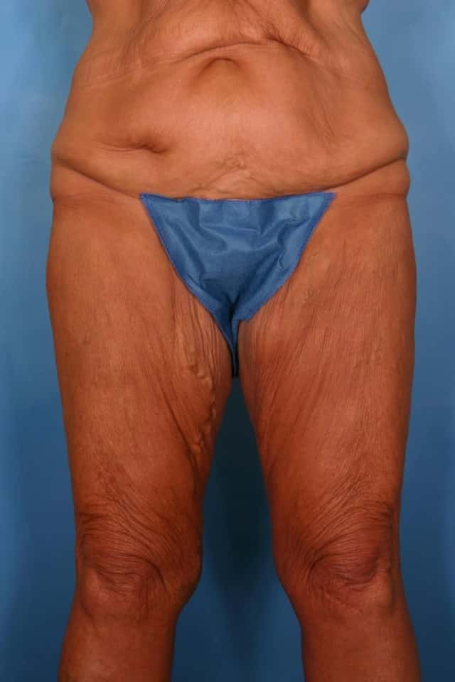 Massive Weight Loss Before & After Case 89 before