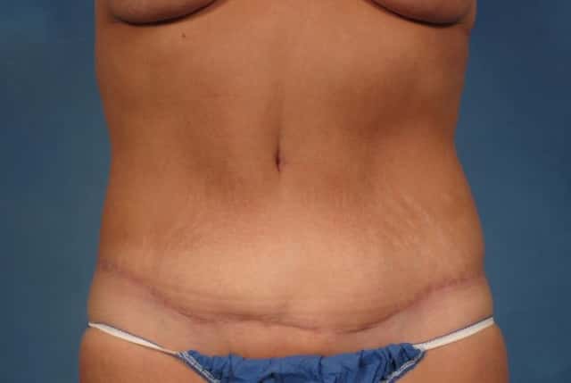 Mommy Makeover Before & After Case 237 after