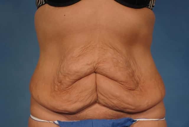 Mommy Makeover Before & After Case 237 before