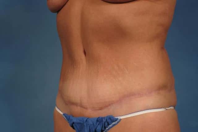 Mommy Makeover Before & After Case 237 after