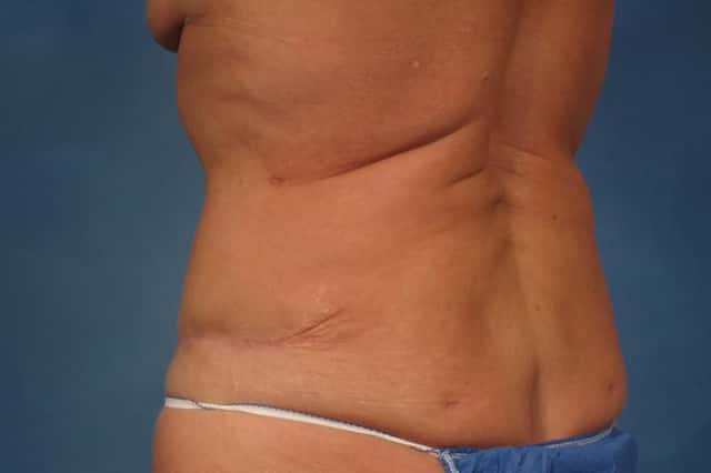 Mommy Makeover Before & After Case 237 after