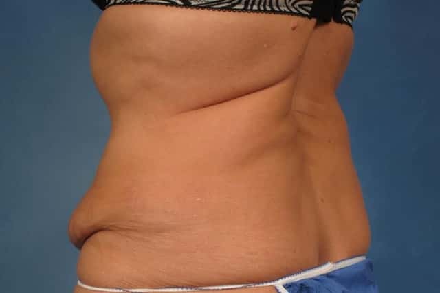Mommy Makeover Before & After Case 237 before