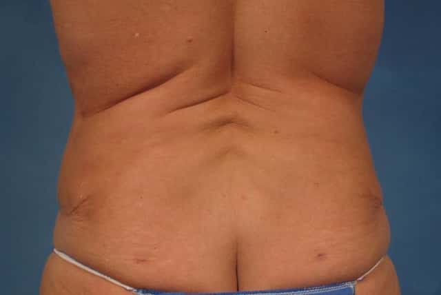 Mommy Makeover Before & After Case 237 after