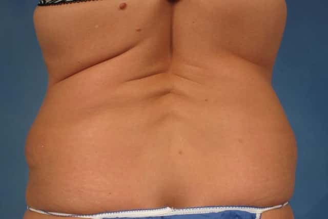 Mommy Makeover Before & After Case 237 before