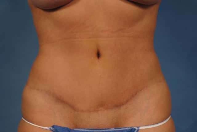 Mommy Makeover Before & After Case 238 after