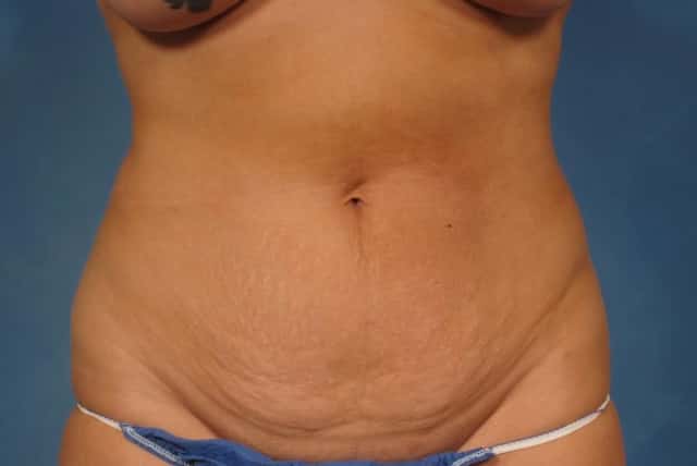 Mommy Makeover Before & After Case 238 before