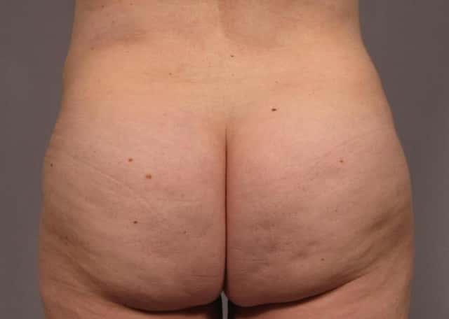 Mommy Makeover Before & After Case 311 after