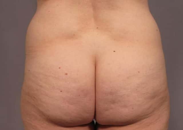 Mommy Makeover Before & After Case 311 before