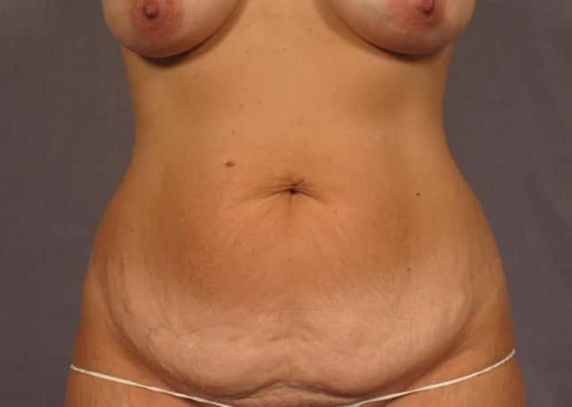 Mommy Makeover with Breast Lift, Tummy Tuck and Liposuction before