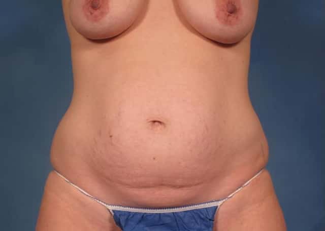 Mommy Makeover, Frontal View, Before and 7 years After Photos by Dr. Kent V. Hasen