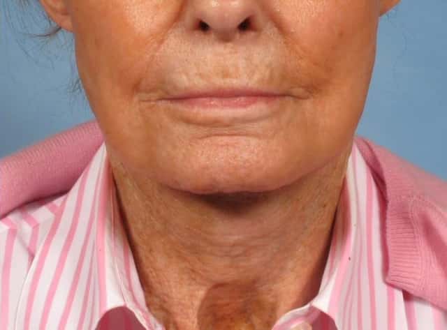 Neck Lift Before & After Case 189 after