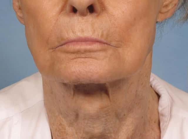 Neck Lift Before & After Case 189 before