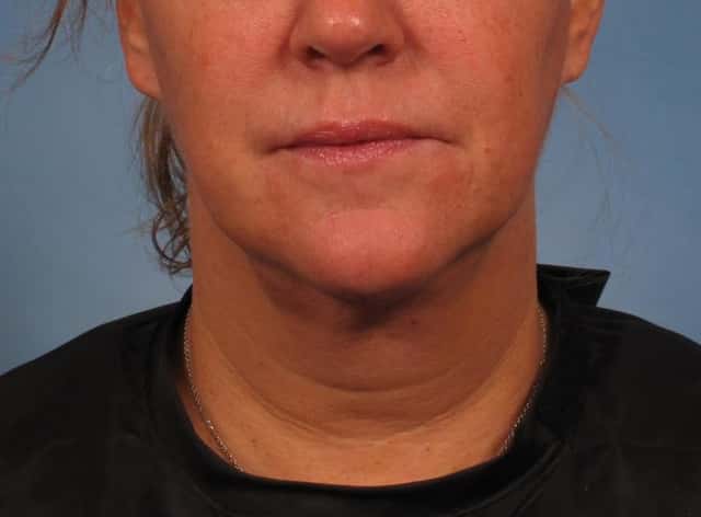 Neck Lift Before & After Case 276 after