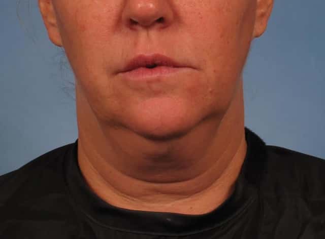 Neck Lift Before & After Case 276 before