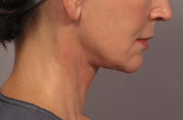 Neck Lift Before & After Case 301 after