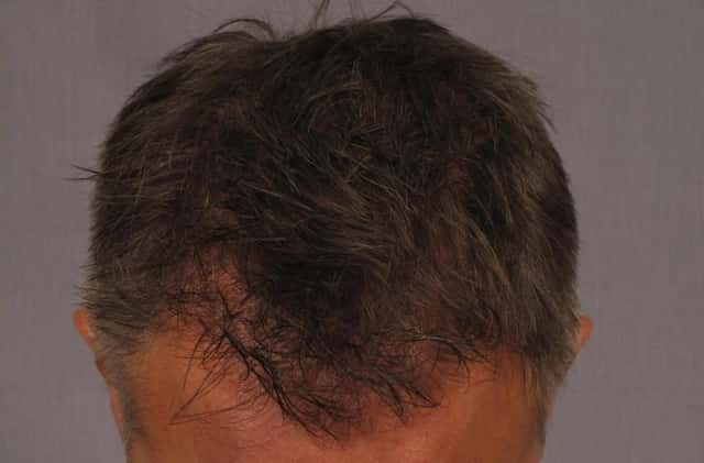 FUE Results Achieved with SmartGraft or Neograft Before & After Case 253 after