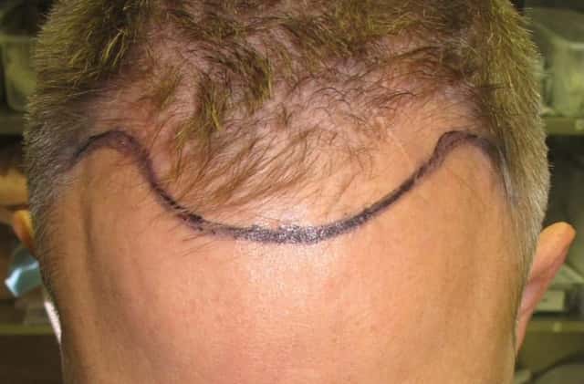 FUE Results Achieved with SmartGraft or Neograft Before & After Case 253 before
