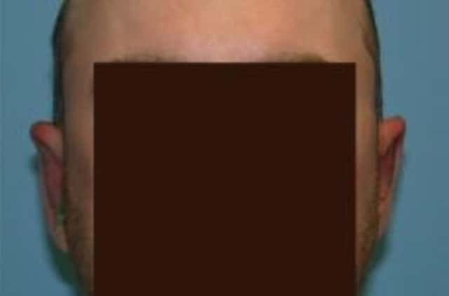 Otoplasty Before & After Case 12 after
