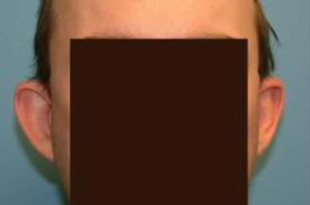 Otoplasty Before & After Case 12 before