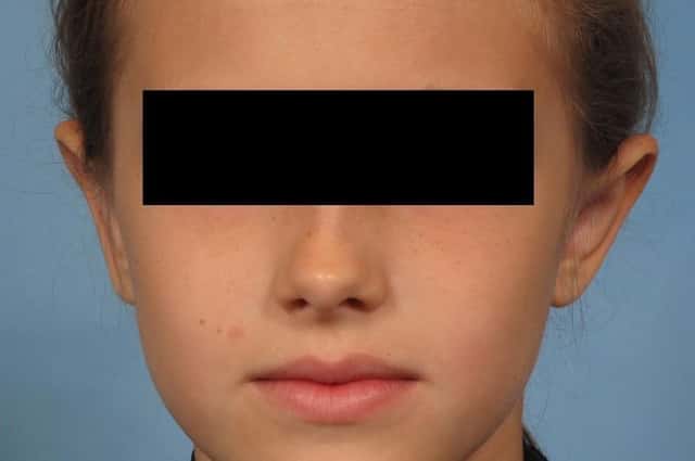 Otoplasty Before & After Case 262 after