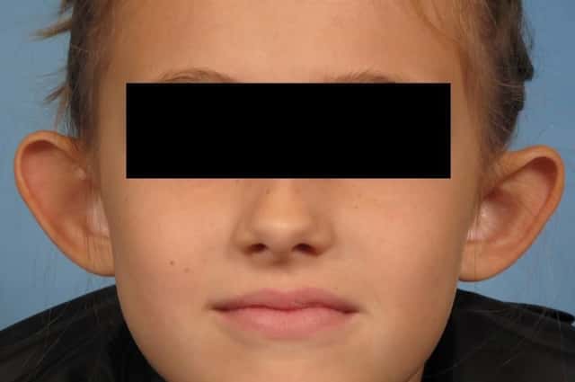 Otoplasty Before & After Case 262 before