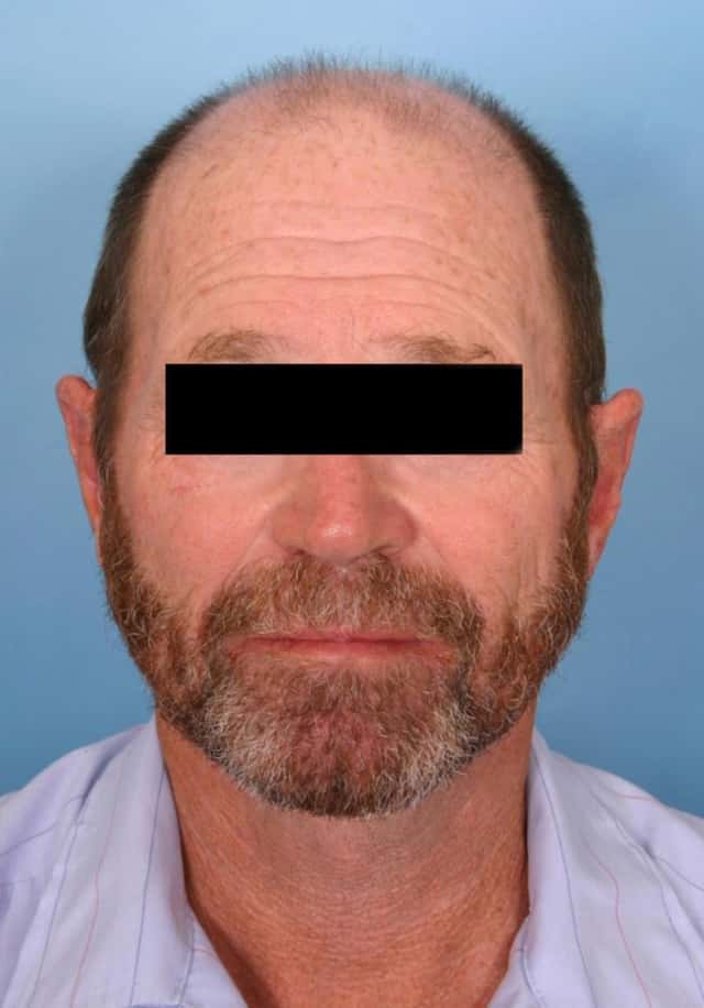 Otoplasty Before & After Case 46 after