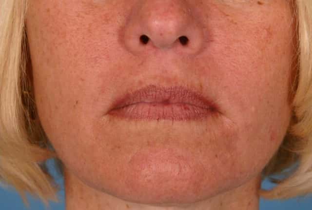 Radiesse® Before & After Case 26 after