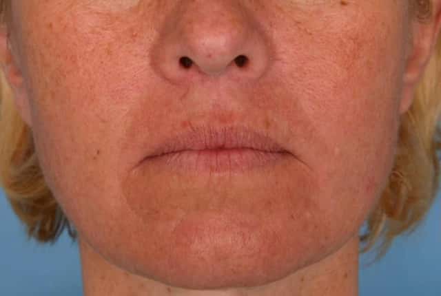 Radiesse® Before & After Case 26 before