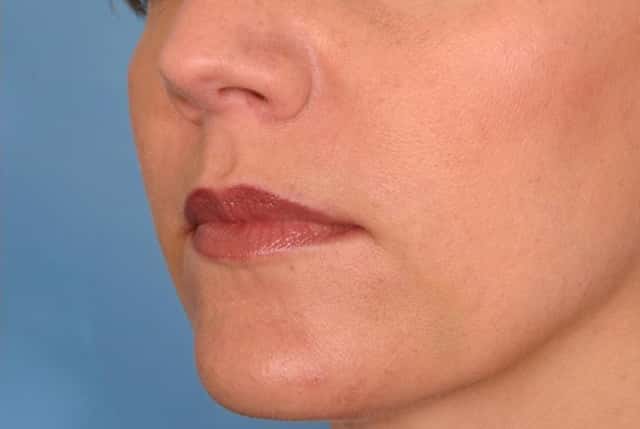 Radiesse® Before & After Case 27 after