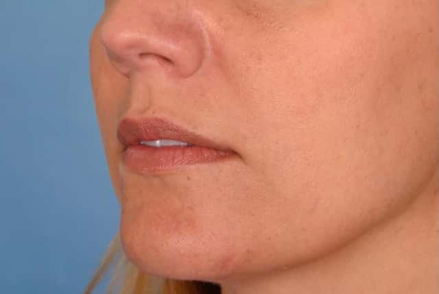 Radiesse® Before & After Case 27 before