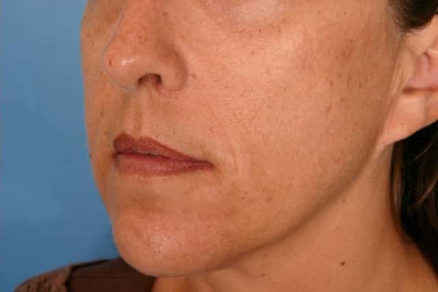 Radiesse® Before & After Case 61 after